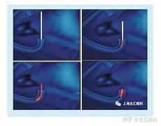 眼睛干涩睁不开眼犯困
