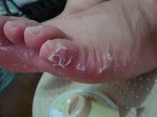 脚气脚趾缝溃烂图片